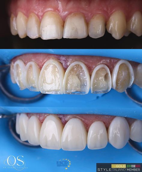 Dr.Osama Shaalan | Free hand palatal shell , unica frame before and after layering the veneering layer . Polished by lucida WDB composite ,SI2 + E +MP… | Instagram Veneers Before And After, Before And After, Dentist Cabinet, Face Plastic Surgery, Cosmetic Dentistry Veneers, Composite Veneers, Dental Photos, Tooth Filling, Best Teeth Whitening Kit