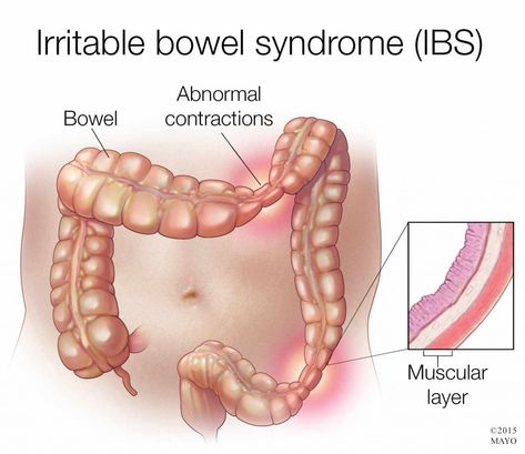 Inflammatory Bowel Syndrome, Irritable Bowel Disease, Probiotic Skin Care, Gastrointestinal Disease, Irritable Bowel, Mayo Clinic, Abdominal Pain, Natural Treatments, Disease