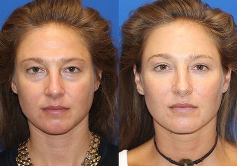 Fat Transfer Before & After Gallery Fat Grafting Face, Fat Transfer To Face, Face Fat Loss Before And After, Breast Fat Transfer, Kpop Plastic Surgery, Jaw Reduction Surgery, V Line Surgery, Aesthetic Procedures, Body Surgery