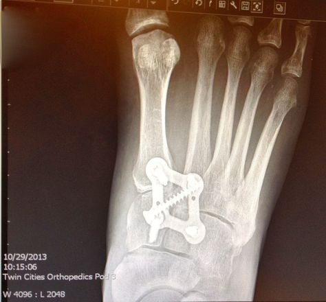 Lisfranc Injury, Broken Foot, Sprained Ankle, Surgery Recovery, After Surgery, Things To Know, Surgery