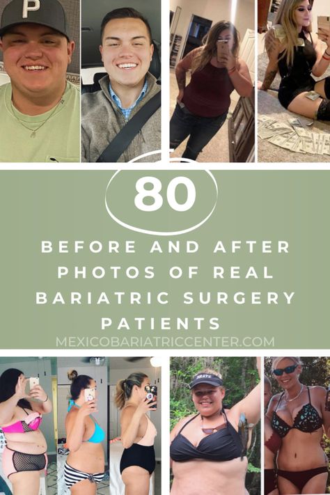 Life After Bariatric Sleeve, Before And After Gastric Bypass Pictures, Gastric Surgery Before And After, Bariatric Bypass Before And After, Gastric Bypass Sleeve Pre Op Liquid Diet, Bariatric Before And After, Bariatric Bypass Surgery, Wls Before And After, After Bariatric Sleeve Surgery