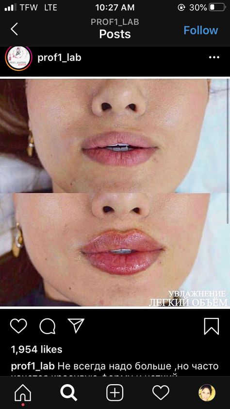 Lip Fillers Before And After 1ml Russian, Russian Lips Filler Before And After, Lip Flip Before And After, Pouty Lip Filler, Lip Injections Before And After, Lip Flip Botox Before And After, Lip Fillers Before And After 1ml, Bad Lip Injections, Russian Lips Filler