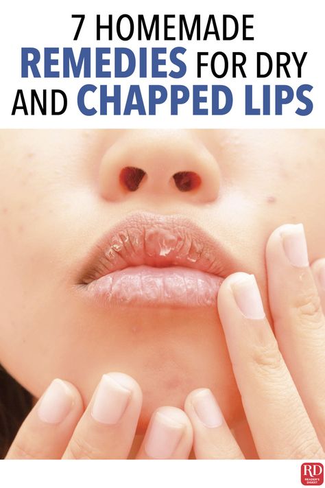 Remedy For Dry Lips, How To Heal Chapped Lips Fast, Chapped Lips Remedy Severe, Remedy For Chapped Lips, Lip Remedies, Dry Lips Remedy, Chapped Lips Remedy, Sore Lips, Lips Care