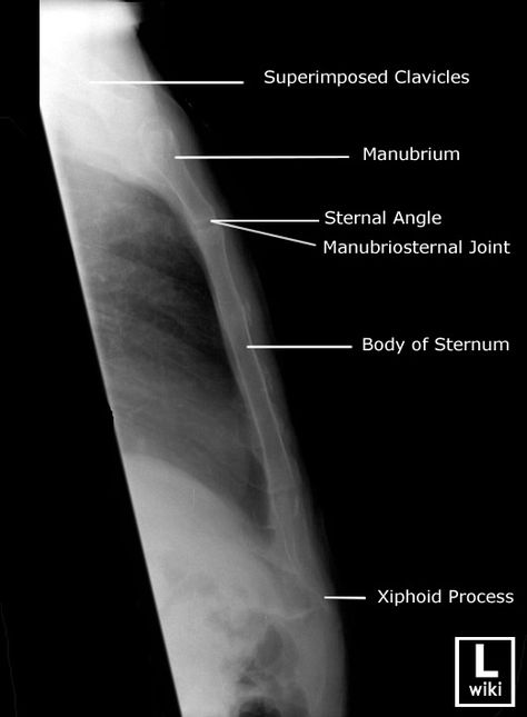 Radiographic Anatomy - Sternum Lateral Radiographic Anatomy, Radiography Student, Rad Tech Student, Radiology Schools, Medical Radiography, Radiologic Technology, Doctor Of Nursing Practice, Radiology Student, Radiology Imaging