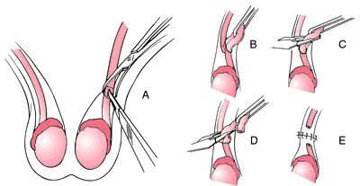 Health Belief Model, Vasectomy Reversal, Medical Dictionary, Consent Forms, Fallopian Tubes, Medical Terms, Family Planning, Medical