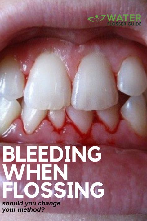 Flossing is one of the two main pillars of your daily oral hygiene regimen. However, more often than not most people encounter a bit of bleeding when flossing. Now, is this a normal thing to expect? Or should it really be looked at in more detail determine exactly why this might be happening? Keep reading for a thorough explanation as to why this is labeled a ‘normal thing’. #flossing #waterflosser #waterpik #comparisons #heartdisease #oralhealth #dentalcare #waterpikcomparisons Teeth Hygiene, Flossing Teeth, Gum Inflammation, Calorie Workout, Dental Cavities, Dental Humor, Water Flosser, Periodontal Disease, Oral Health Care