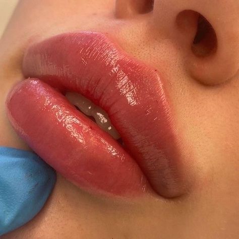 Lips Inspiration, Botox Lips, Facial Fillers, Facial Aesthetics, Lip Filler, Lip Shapes, Lip Injections, Perfect Lips, Nose Job