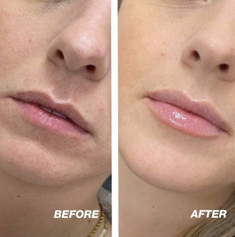 Perfect Lip Filler Shape, Small Lip Injections Before And After, Small Lip Injections, Kendall Jenner Lip Fillers, 5 Ml Lip Filler, Flat Lips Filler, Small Lips Lip Filler, Kysse Lips Filler Before And After, Lip Filler Inspiration Small Lips