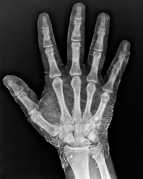 A radiograph of a hand dipped in iodine. The density of the fluid on the surface allows the visibility of soft structures that a radiograph would not normally show in detail. X Ray Hand, Xray Humor, Hand Anatomy, Radiology Technologist, Hand Reference, Anatomy For Artists, Anatomy Drawing, Wow Art, Mini Lessons