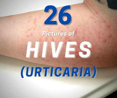 Healing Codes For Skin Allergy, Itchy Bumps On Skin, Skin Allergy Pictures, Hives On Face, Gluten Allergy Rash, How To Treat Hives, Hives Relief, Allergy Hives, Skin Rashes Pictures