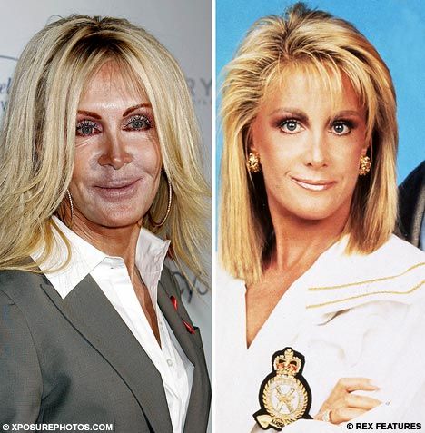 Not all plastic surgery works...let this be a reminder.  http://ritsukakunx.hubpages.com/hub/Joan-Van-Ark-Plastic-Surgery-Disaster Courtney Cox Plastic Surgery, Joan Van Ark, Plastic Surgery Pictures, Botched Plastic Surgery, Bad Plastic Surgeries, Plastic Surgery Fail, Plastic Surgery Photos, Plastic Surgery Gone Wrong, Plastic Surgery Procedures