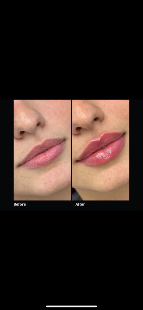 Lip Fuller Shapes, Lip Fillers Heart Shape, Lips Filer Shape, Lip Filler Heavy Upper Lip, Heart Shape Lips Fillers, Lip Filler 2ml, Lip Filler Shape Ideas Pouty, Lip Filler Shape Ideas 1ml, Bow Shaped Lip Filler