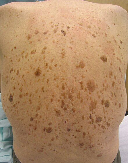 Seborrheic keratosis - Wikipedia Liver Spot, Seborrheic Keratosis, Age Spots On Face, Remove Skin Tags Naturally, Brown Spots On Skin, Skin Moles, Skin Bumps, Skin Growths, Mole Removal