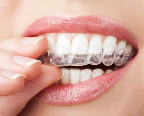 Teeth Whitening Methods, Invisalign Aligners, Invisalign Braces, Clear Braces, Teeth Whitening Remedies, Teeth Whitening Diy, Diy Teething, Clear Aligners, Straight Teeth