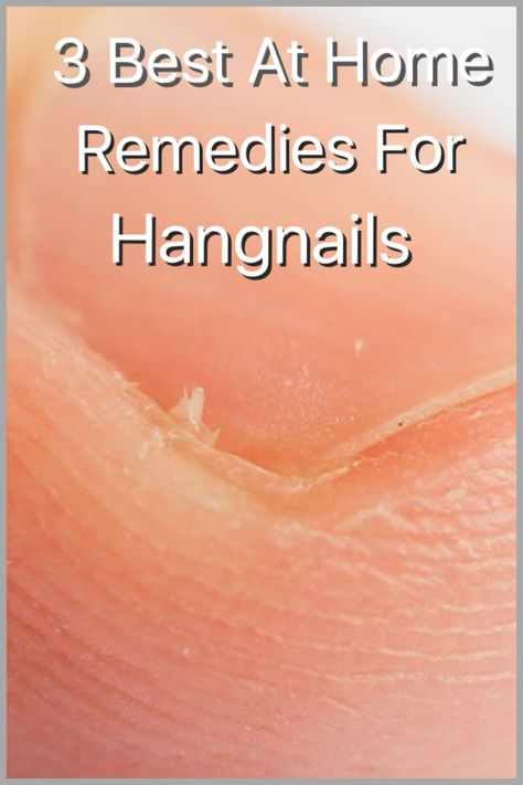 Hangnails are the worst. You know, those dry pieces of skin that peel off around your cuticles… No matter how perfect your manicure looks, those little skin flaps find a way to downgrade your nail game. Not to mention, um, OW! They hurt, they swell, they get infected, OH MY! Quite the pests… Hangnail Remedy How To Get Rid, Skin Around Nails Peeling, How To Prevent Hang Nails, Infected Hangnail Remedy, Infected Cuticle Remedy, How To Stop Hang Nails, Hang Nails How To Get Rid Of, Hang Nail Remedy Infected Finger, Peeling Nails Remedy