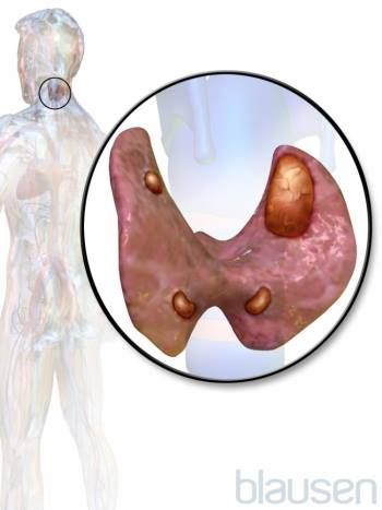 Hypercalcemia (High Level of Calcium in the Blood) - Hormonal and Metabolic Disorders - Merck Manuals Consumer Version Parathyroid Symptoms, Parathyroid Hormone, Parathyroid Disease, Multiple Endocrine Neoplasia, High Calcium, Metabolic Disorders, Gluten Sensitivity, Thyroid Health, Health Guide