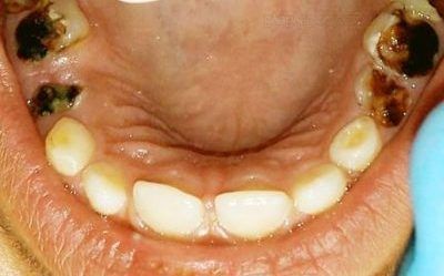 Why Are My Teeth Rotting And How To Stop Them From Rotting Further? &mdash; Electrical Toothbrush, Rotting Teeth, Medical Laboratory Science Student, Teeth Hygiene, Best Electric Toothbrush, Rotten Teeth, Tooth Cavity, Heal Cavities, How To Get Healthy