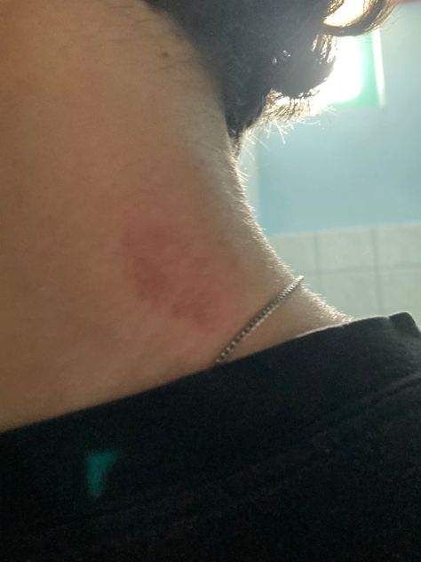 Hickey On Boy, Hickey Neck Tattoo, Guy With Scratch On Back, Hickey Neck Aesthetique, Heart Made Of Hickeys, Neck Bite Boyfriend, Neck Full Of Hickeys, Hicks On Neck, Hickies Neck Aesthetic