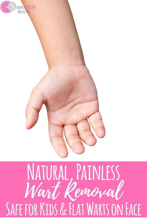 Wondering how to get rid of warts? Don't fret. There is a perfectly natural way to aid with that. Even though there are various types of warts out there, you can still use this natural and homemade painless remedy. Safe to even use on kids as well! Don't let harsh chemicals come in contact with your plantar wart when you can use this instead. Safe to use on your foot, hands, face or other external areas of the body. #wartremoval #plantar #beauty #health #essentialoils Flat Warts, Types Of Warts, Plantar Warts, Warts Removal, Warts On Hands, Warts On Face, Remove Skin Tags Naturally, Home Remedies For Warts, Warts Remedy