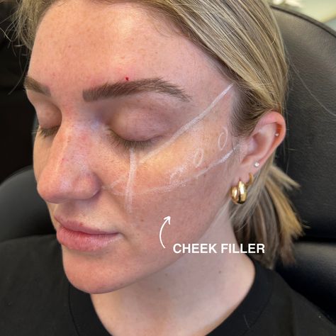 Wanting to achieve more facial symmetry? Cheek filler is a total must!✨ 

👉🏼 Enhance your natural contours and elevate your look with just a few quick injections. It’s an easy way to add volume and balance to your features. 

📅 Book your appointment today and let’s create your ideal look! 

#TrulyYouMedSpa #CheekFiller #FacialSymmetry #LakeCityFL Facial Symmetry, Vampire Facial, Cheek Fillers, Painless Hair Removal, Hair Removal Methods, Natural Contour, Cosmetic Treatments, Best Version Of Yourself, Cosmetic Procedures