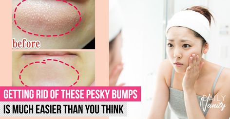 Those pesky bumps on your chin are closed comedones, which aren't pimples. Here, we show you 5 ways to make them disappear! How To Get Rid Of Closed Comedones, Bumps On Chin, Makeup Removal Routine, Closed Comedones, Inflamed Pimple, Bump Hairstyles, Deep Cleansing Facial, Clean Blackheads, Acne Help