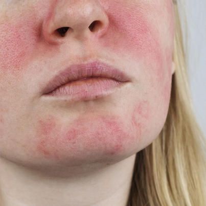 WebMD - Moderate to severe atopic dermatitis can make it... Atopic Skin, Things To Try, Forehead Wrinkles, Skin Disorders, Skin Remedies, Anti Aging Tips, Skin Issues, Blood Vessels, Dermatology