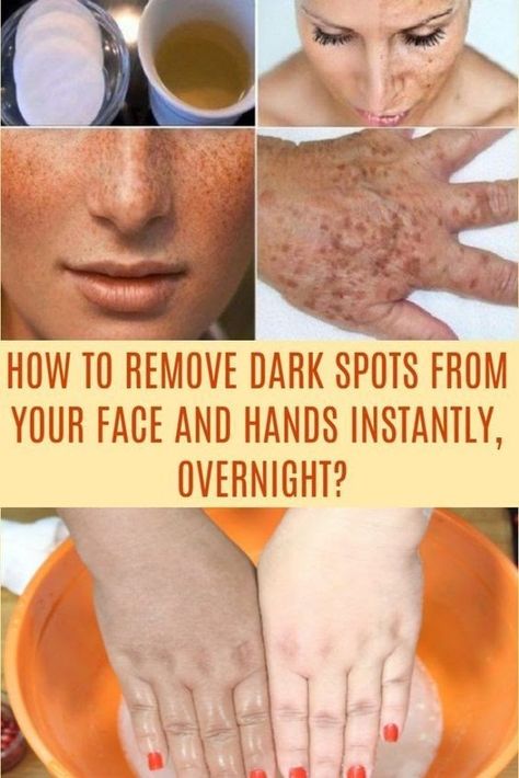 How To Get Rid of Pigmentation And Dark Spots Naturally - Food Blog How To Remove Moles, Sun Spots On Skin, Black Spots On Face, Remove Moles, Brown Age Spots, Brown Spots On Skin, Skin Moles, Mole Removal, Skin Tags