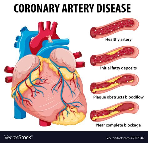 Foot Reflexology Massage, Coronary Artery, Angina Pectoris, Heart Muscle, Coronary Arteries, Educational Infographic, Healing Touch, Cardiology, Cardiovascular Disease