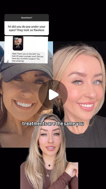 SNATCHED BEVERLY HILLS on Instagram: "Love sharing my under eye journey with you guys 🤓👀💉  Have you tried PRP injections before?" Under Eye Prp Before And After, Prp Injections Under Eyes, Prp Undereye Before And After, Upper Blephoraplasty Before And After, Under Eye Filler Before And After, Under Eye Filler, Under Eye Fillers, Cheek Fillers, Fat Transfer