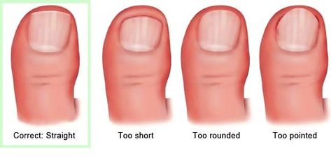 Ingrown Toenail, Ingrown Nail, How To Cut Nails, Ingrown Toe Nail, Homemade Remedies, Foot Health, Foot Care, Feet Nails, Body Skin Care