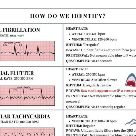 shanu.ECG on Instagram: "EKG Rhythms Cheat Sheet!!🫀Learn to identify and treat these rhythms. This is PACKED with info…I tried to make it as simple as I can for y’all 🥰 Save and share with a friend!! . Follow us for more information 👇 @knowledge.of.ecg . . Thanks for this post @stephaneebeggs . . #ecg #ekg #cardiology #ecginterpretation #electrocardiograma #electrocardiogram #nursing #cardiologista #healthy #interpretation #heart #nurse #knowledgeofecg #hearts #heartbeat #ccu #cardio #cardiov Cardio Nursing Cheat Sheets, Ekg Interpretation Cheat Sheet, Ecg Rhythms Cheat Sheets, Ekg Rhythms, Ekg Interpretation, Nursing Cheat Sheet, Ecg Interpretation, Pr Interval, Nursing Cheat