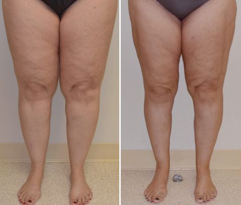 Leg Lymph Drainage, Lipedema Massage, Lipedema Outfit, Lipedema Diet Plan, Lipedema Exercise, Lipedema Before And After, Edema How To Get Rid Of, Lipedema Surgery, Lymphodemia Diet