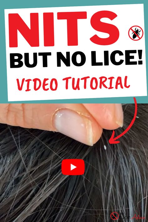 Lice And Nits Remedies, Best Way To Get Rid Of Lice And Nits, How To Remove Nits From Hair, How To Get Rid Of Lice Eggs, Home Remedy For Lice And Nits, How To Get Rid Of Nits In Hair, Getting Rid Of Lice Fast, Natural Remedies For Lice, How To Remove Lice Eggs From Hair