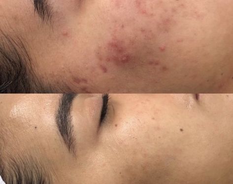 Esthetician Before And After, Skin Before After, Before And After Facial Pictures, Before And After Microneedling, Facials Before And After, Skin Before And After, Dermapen Before And After, Micronidelling Face, Microdermabrasion Before And After