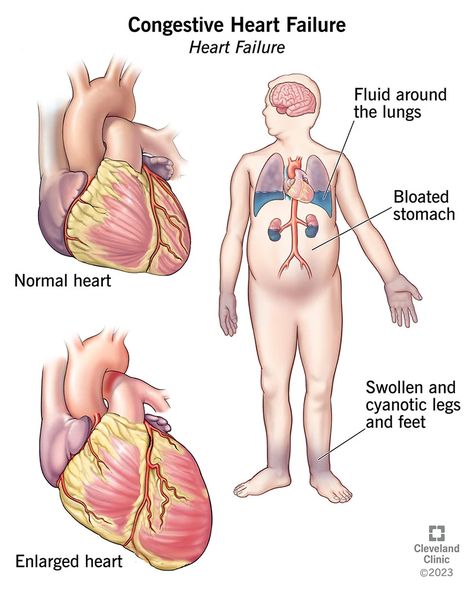 Best Cough Remedy, Alcohol Use Disorder, Chronic Cough, Cleveland Clinic, Natural Cough Remedies, Mole, Disease