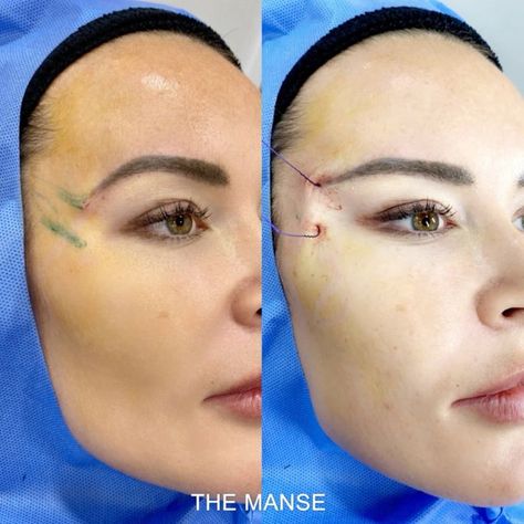 #plasticsurgery #plasticsurgerygonewrong #beforeafter #celebritiesbeforeafter #hollywoodstars #bignosesurgery #surgery #facesurgery #vlinesurgery #koreanplasticsurgery #kpopplasticsurgery #nosejob #jawreductionsurgery #eyesurgery #cheekfillers #rhinoplasty #facelift #plasticsurgeryfails #expensiveplasticsurgery #viral Eye Thread Lift, Eye Lift Surgery, Thread Lift Face, Jaw Reduction Surgery, Botox Brow Lift, Sagging Face, Plastic Surgery Fail, Plastic Surgery Gone Wrong, Face Surgery