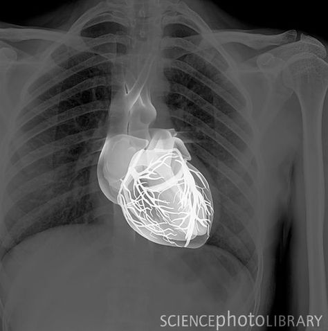 The heart X-ray (centre) has been aligned with a chest X-ray to show where the heart is located within the human rib cag Human Ribs, Human Rib Cage, Medical Images, Xray Art, Heart And Lungs, Science Photos, Medical Art, Medical Science, Anatomy And Physiology