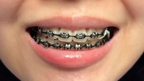 Baddie Braces, Black Braces Teeth, Dental Braces Colors, Braces Ideas, Black Braces, Cute Braces Colors, Adult Braces, Kids Braces, Shiny Nails Designs