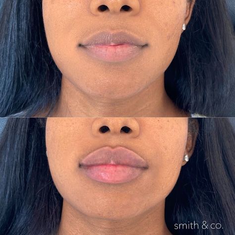 Lip Injections Before And After Black Women, Lip Filler Black Women, Lip Filler Before And After, Lip Filler Technique, Face Injections, Ombré Lips, Spa Aesthetic, Lip Lift, Skin Anatomy