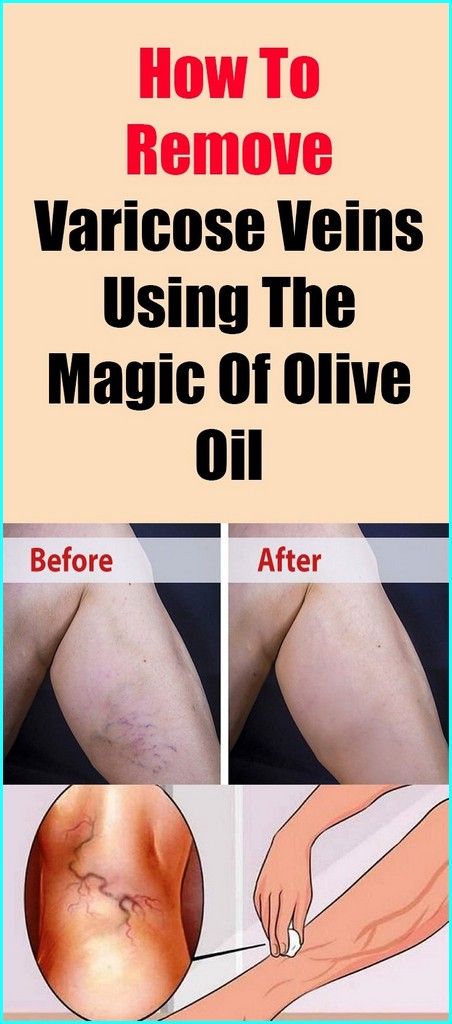 How To Remove Varicose Veins Using The Magic of Olive Oil Varicose Vein Removal, Varicose Vein Remedy, Vein Removal, Home Medicine, Natural Drinks, Diy Remedies, Body Hacks, Natural Treatments, Lifestyle Tips