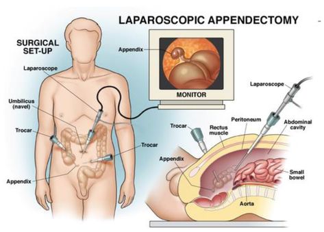 Appendectomy Recovery, Gallbladder Surgery, Abdominal Surgery, Laser Surgery, Medical Photos, Laparoscopic Surgery, General Surgery, Medical School Essentials, Surgery Recovery