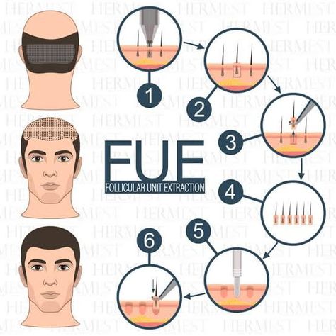 Hair transplant FUE Hair Science, Hair Transplant Results, Fue Hair Transplant, Tea Health Benefits, Hair Clinic, Grow Hair Faster, Hair Restoration, Hair Transplant, Grow Hair