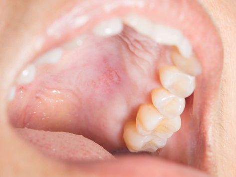 Roof Of Mouth Sore, Swollen Uvula, Canker Sore Causes, Tongue Problems, Sore Jaw, Salivary Gland, Jaw Pain, Strep Throat, Canker Sore