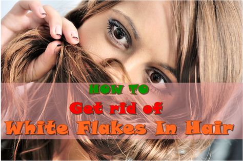 How To Get Rid Of White Flakes In Hair Flaking Skin, Dry Flaky Skin, Diy Remedies, Flaky Skin, Cut And Color, Card Templates, Health And Beauty, Hair Cuts, Spray