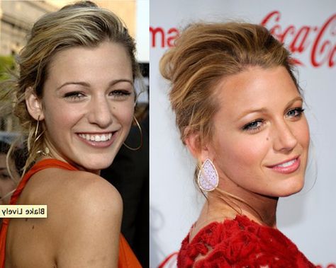 Blake Lively nose job 2005 vs 2011. Blake Lively Before Nose Job, Natural Nose Job Before After, Lele Pons Nose Job, Jennifer Aniston Nose Job, Blake Lively Nose, Natural Nose Job, Nose Ideas, Aesthetic Procedures, Blake Lively Hair