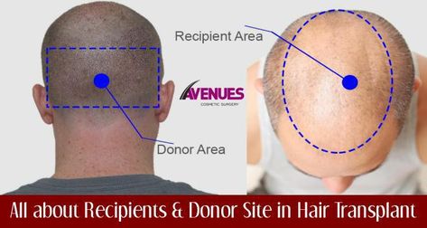 At the Avenues clinic, you can deal with the baldness issue with the help of talented Hair doctor in Ahmedabad because of the great and creative skills of the surgeons. Those hair loss specialists are trained to make use of the donor and recipient areas effectively. Perfect Hairline, Donating Hair, Hair Transplant Cost, Global Hair, Hair Doctor, Cosmetic Clinic, Best Hair Transplant, Hair Clinic, Hair Specialist