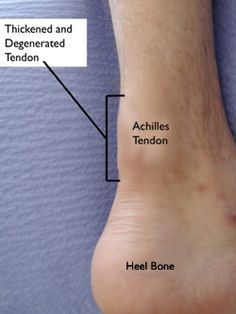 Achilles Tendon Ruptures, Achilles Tendinopathy, Nerve Pain Remedies, Achilles Pain, Soft Tissue Injury, Ankle Surgery, Ankle Pain, Nerve Pain Relief, Knee Exercises