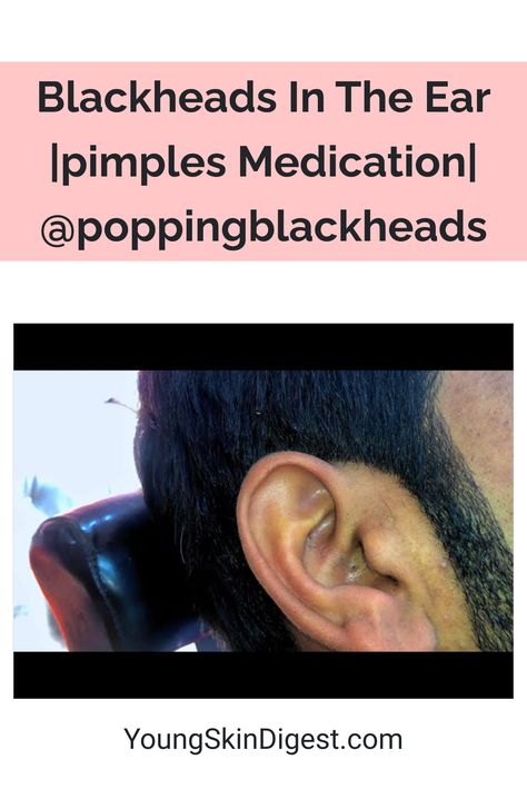 Blackheads In The Ear |pimples Medication| @poppingblackheads Pimples In Ear, Ear Blackheads, Black Head Removal Video Nose, Blackheads On Back, Huge Blackheads, Acne Recipes, Blackheads On Cheeks, Ear Pimple, Pimple Causes