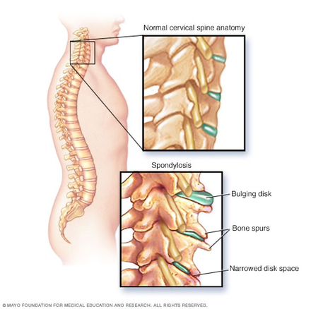 Jaw Pain Relief, Cervical Spondylosis, Neck Problems, Spinal Surgery, Neck Relief, Lumbar Spine, Jaw Pain, Spine Health, Nerve Pain Relief