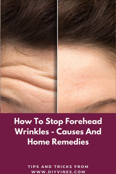 How To Stop Forehead Wrinkles - Causes And Home Remedies #foreheadwrinkles #foreheadwrinklescauses #foreheadwrinklesprevention #foreheadwrinklesremovalremedies #beauty #beautytips #skincare #skincaretips #remedies #homeremedies #DIY #acne #acnescars #darkspots #skinspots Get Rid Of Deep Forehead Wrinkles, How To Stop Forehead Wrinkles, Dry Forehead, Natural Wrinkle Remedies, Home Remedies For Wrinkles, Anti Aging Remedies, Wrinkle Remedies, Wrinkle Free Skin, Diy Acne